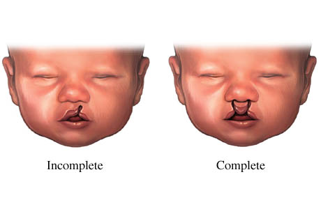 Two examples of cleft lip