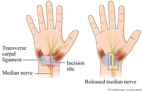 Open carpal tunnel release surgery