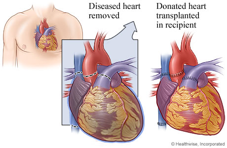 Diseased heart showing where blood vessels were detached and transplanted  heart showing where blood vessels were attached 