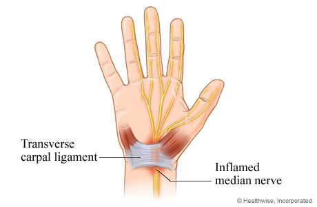 Inflamed median nerve in carpal tunnel syndrome