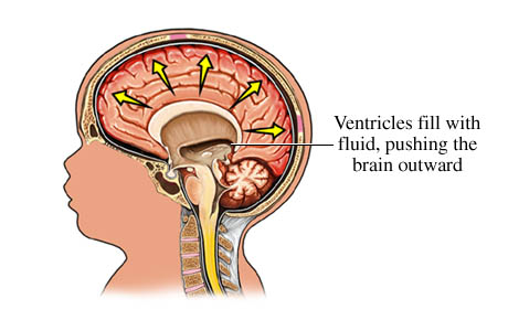 Picture of congenital hydrocephalus