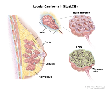 Breast Cancer Treatment (PDQ®): Treatment - Patient Information [NCI]