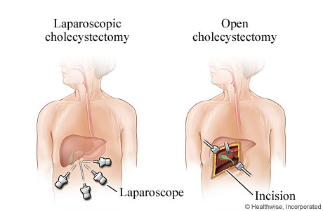 Laparoscopic and open gallbladder removal surgery