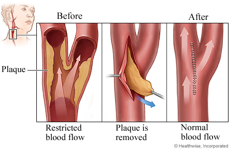 Carotid endarterectomy procedure